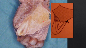 part3 - anatomiques - Les bases anatomiques en chirurgie implantaire - Structures et dangers anatomiques au maxillaire